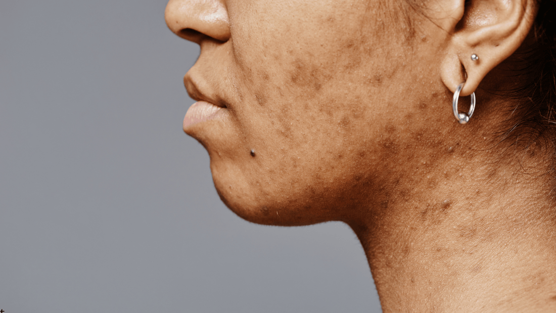 Närbild på akneärr och postinflammatorisk hyperpigmentering på kind – hudstruktur före microneedling behandling mot akneärr